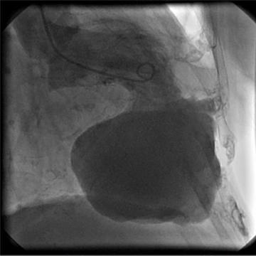 A curious case of an elderly lady readmitted for repeated heart failure