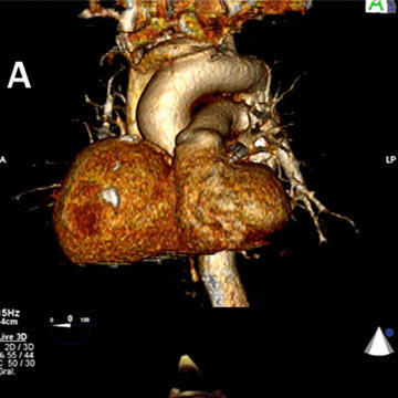 An unexpected giant cardiac mass