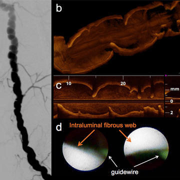 Brachial artery fibromuscular dysplasia