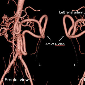 Middle aortic syndrome: a rare cause of juvenile hypertension