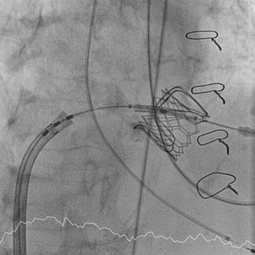 Percutaneous mitral valve intervention. A frontier no more