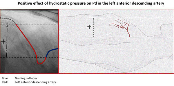 Figure 2. Left lateral fluoroscopic view at 90 degrees in order to adequately assess the height difference between the two pressure sensors in the mid LAD (red) and opening of the guiding catheter (blue). The height difference measured with angio tool was 44 mm.