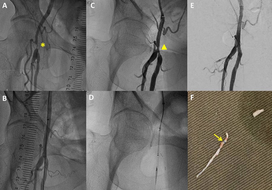 A) Angiogram showed severe focal right CFA stenosis B) Satisfactory angiographic result was achieved after POBA. C) Second angiogram revealed restenosis in the right CFA D) Directional excisional atherectomy was performed. E) Final angiographic result was satisfactory. F) Examination of debris revealed suspicion of retained surgical stitches.