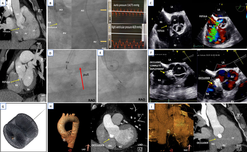 Interventional approach of an aortic fistula after endocarditis