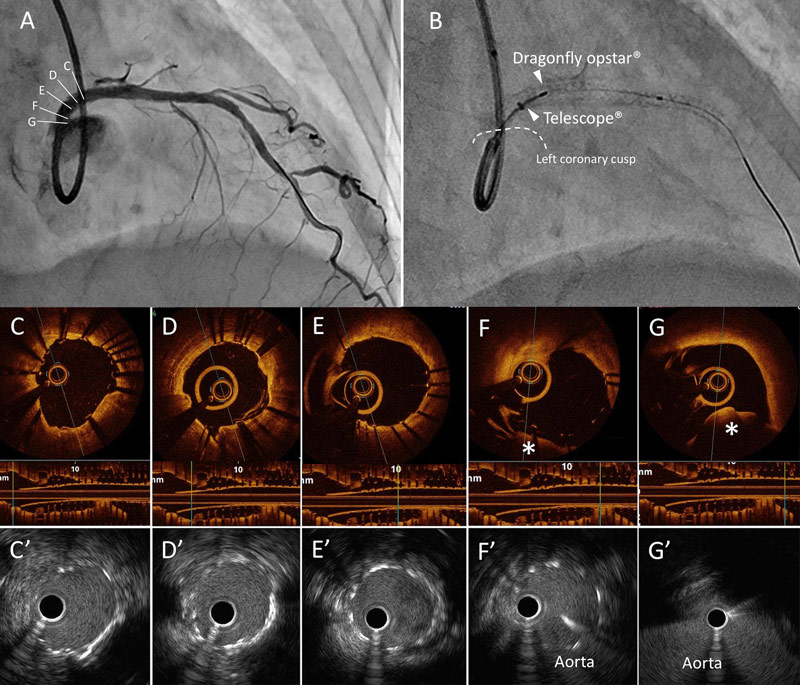 Aorto-ostial Lesion Observation by Optical Coherence Tomography