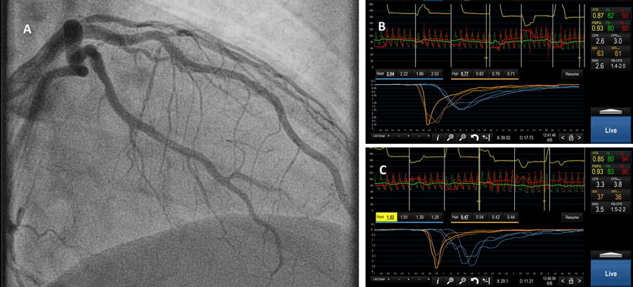 Coronary sinus reducer for microvascular angina