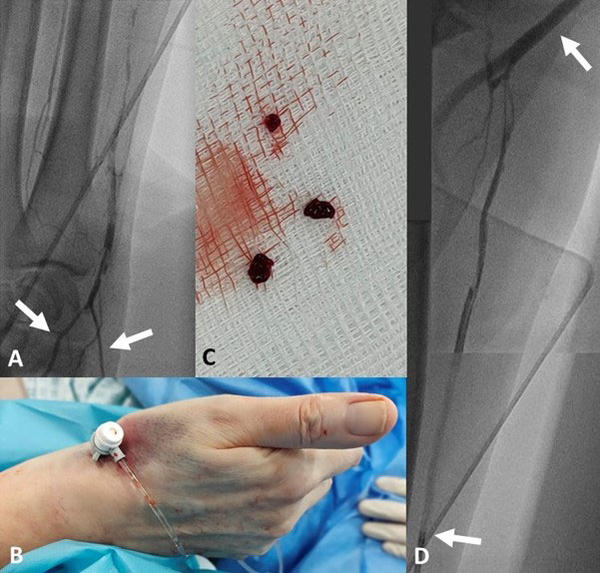 Reaccessing and recanalizing the occluded radial artery