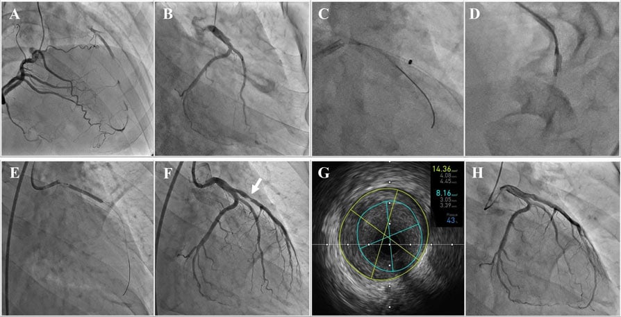 Successful Stent-less Percutaneous Coronary Intervention of Chronic Total Occlusion by Ablation Devices in a Young Adult
