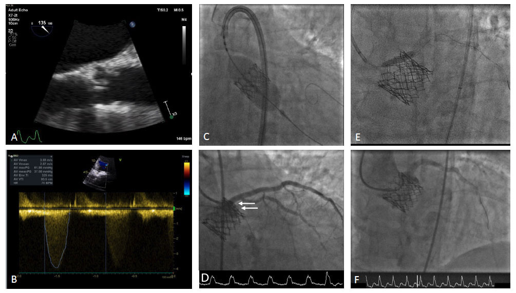 Figure-1-crash-tavi-in-tavi-complicated-by-coronary-obstruction-transthoracic-echocardiography-demonstrating-severe-degeneration