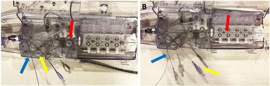The device cassette of the CorPath GRX (Corindus Vascular Inc, USA) R-PCI system. (A) The active wire drive (red arrow) and active device drive (yellow arrow) allow for a single wire and device (balloon or stent) to be controlled robotically, with the passive drive (blue arrow) used to store multiple additional wires and/or devices. (B) For the hybrid DK Crush approach, the cassette was initially prepared with the side-branch circumflex wire (red arrow) and pre-dilatation balloon (yellow arrow) loaded into the active wire and device drives respectively with the main branch LAD wire and pre-dilatation balloon loaded in the passive drive (blue arrow)