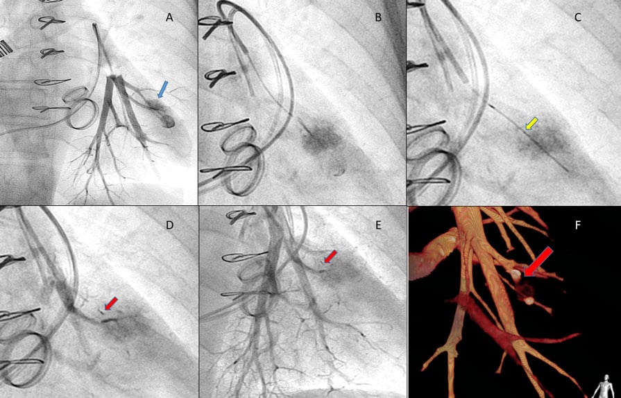 Figure 1 - Repair of iatrogenic perforation of a pulmonary artery side branch with Micro Vascular Plug System
