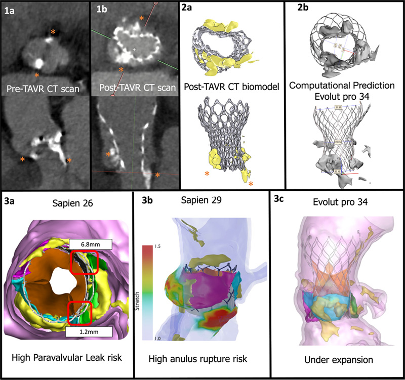 Application of predictive modeling in complex TAVR