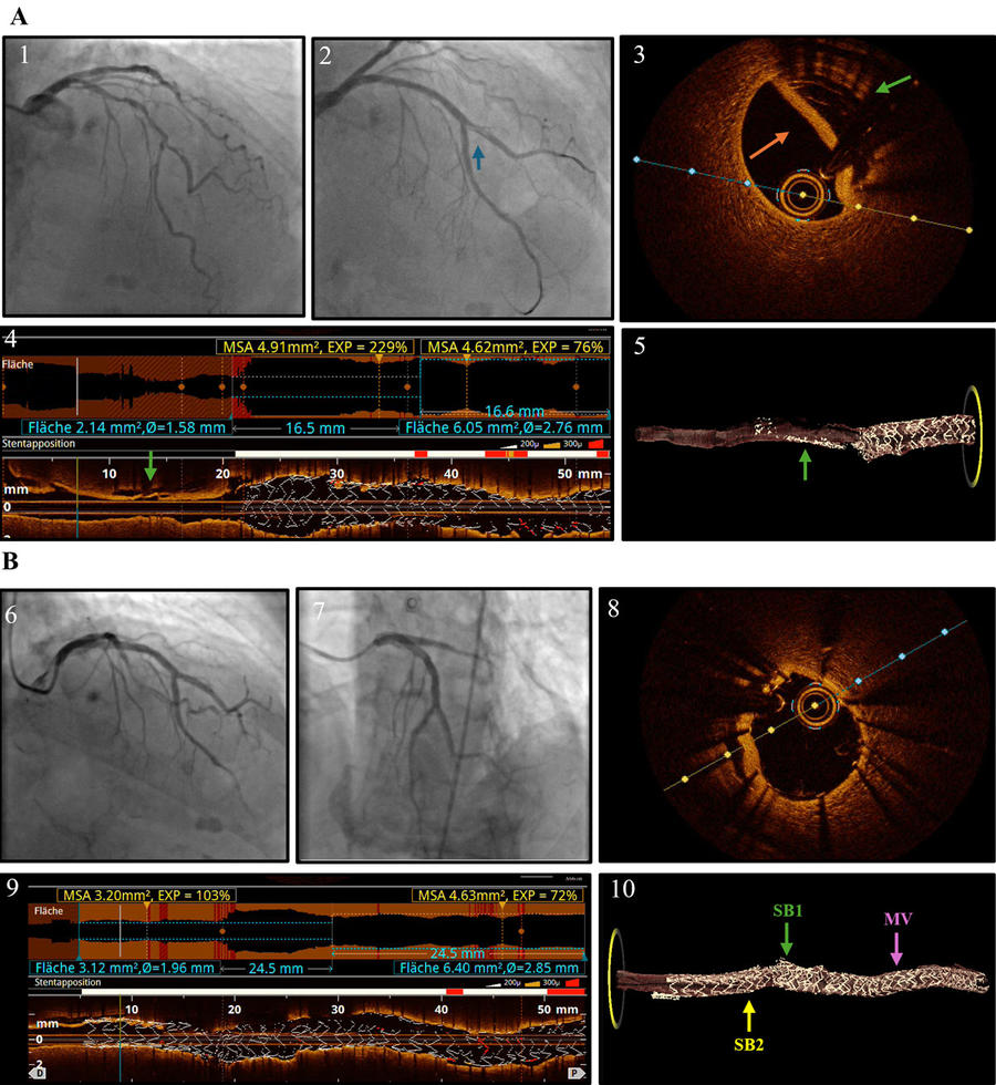 Figure 1. Troubleshooting of a complicated subendothelial dissection using 2D and 3D OCT.