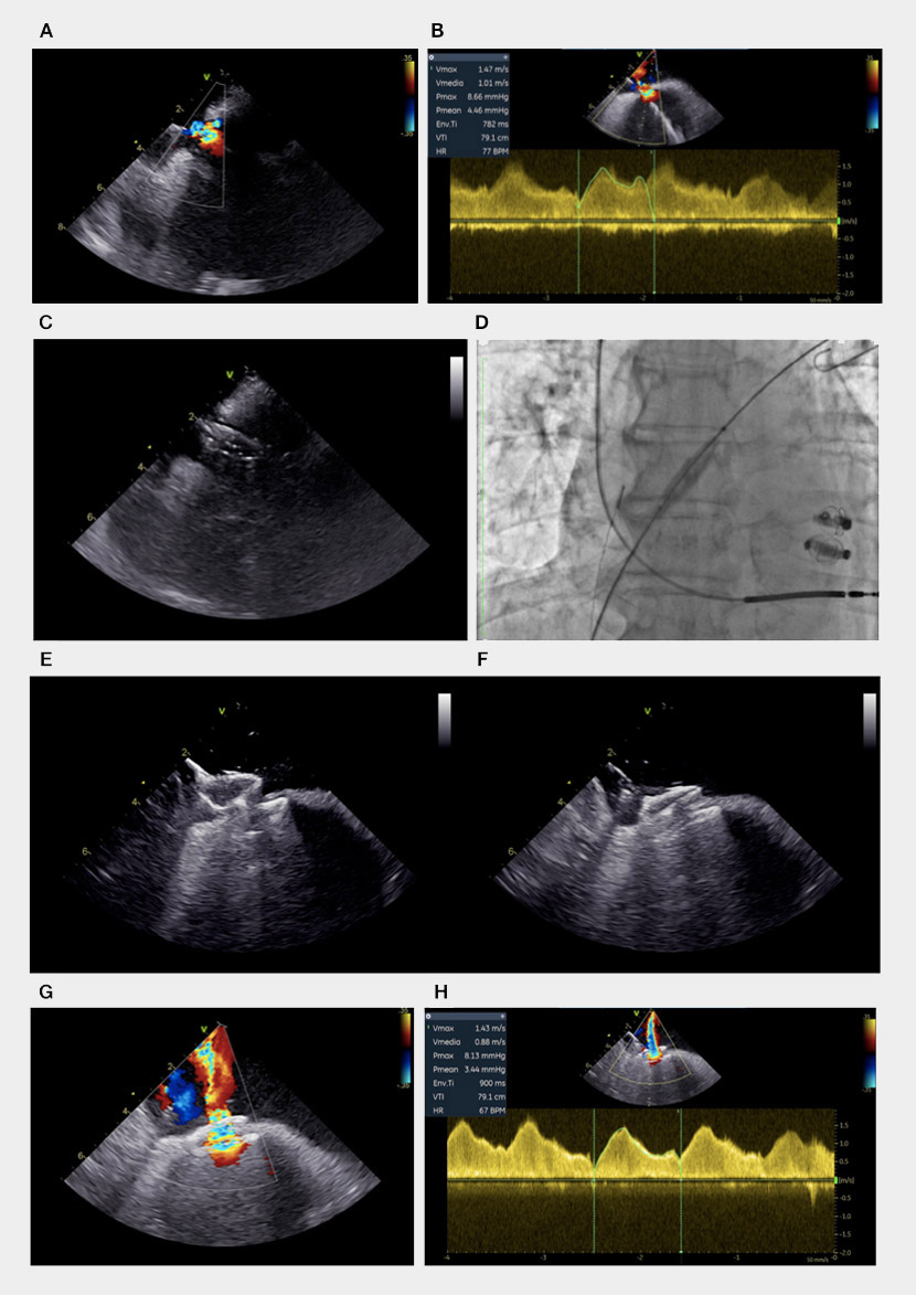 Different steps of intertrial shunt device implantation. ASD, ICE visualization (A) and continuous wave evaluation (B); balloon septostomy, ICE (C) and fluoroscopic visualization (D); AFR pre-release push and pull manoeuvre, ICE visualization (E-F); Final interatrial shunt, color doppler (G) and continuous wave evaluation (H). 