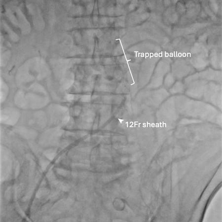 Figure 1A: Failed balloon retrieval.