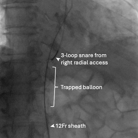 Figure 1B: Snaring from right radial access.
