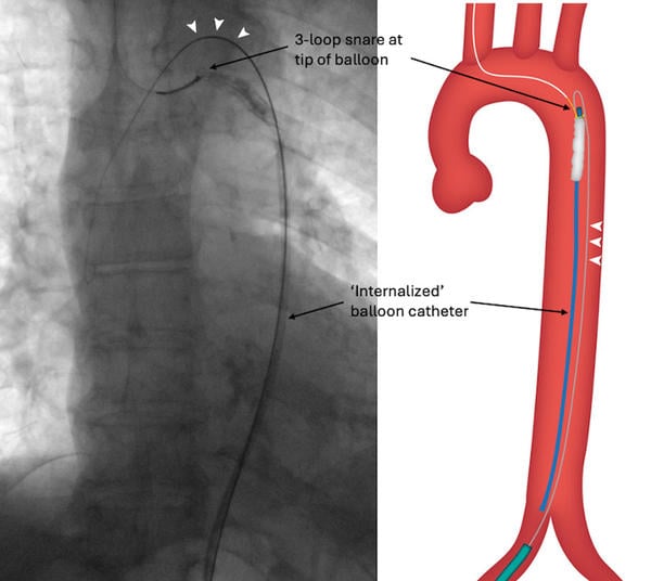 Figure 1C: ‘Internalization’ of balloon with a 0.035’ wire running parallel to it (arrowheads).
