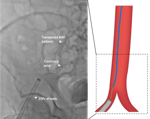 Figure 1D: ‘Tip-in’ rewiring of central lumen of transected valvuloplasty balloon.