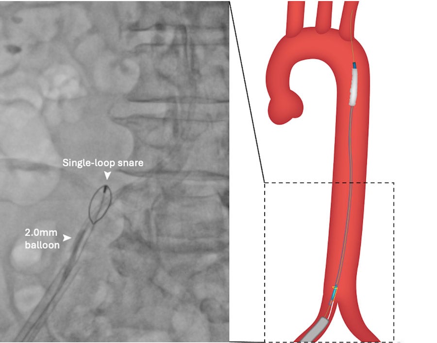 Figure 1E: Ipsilateral snaring and 2-mm balloon anchoring in central lumen of transected balloon.