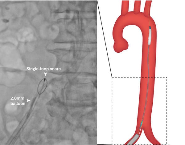 Figure 1E: Ipsilateral snaring and 2-mm balloon anchoring in central lumen of transected balloon.
