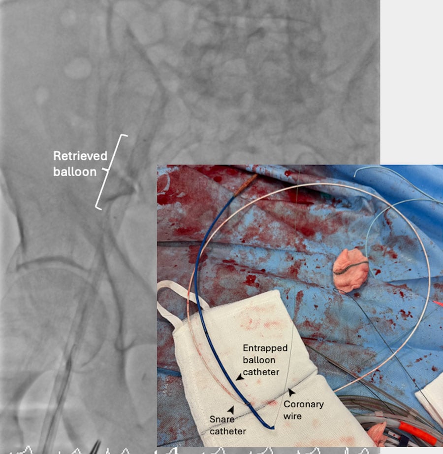 Internal anchoring with a 2-mm balloon inflated within the wire lumen of the transected valvuloplasty balloon and ipsilateral snaring with a 5-mm Amplatz Goose Snare (Medtronic) straightened the system and allowed successful retrieval of the balloon. (Figure 1F)