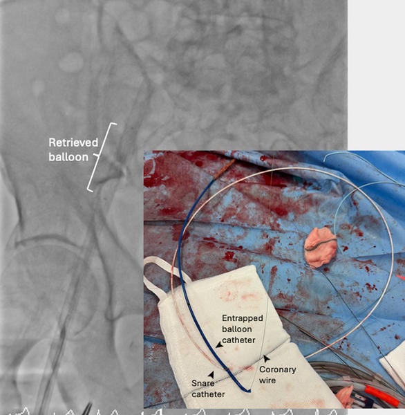Internal anchoring with a 2-mm balloon inflated within the wire lumen of the transected valvuloplasty balloon and ipsilateral snaring with a 5-mm Amplatz Goose Snare (Medtronic) straightened the system and allowed successful retrieval of the balloon. (Figure 1F)