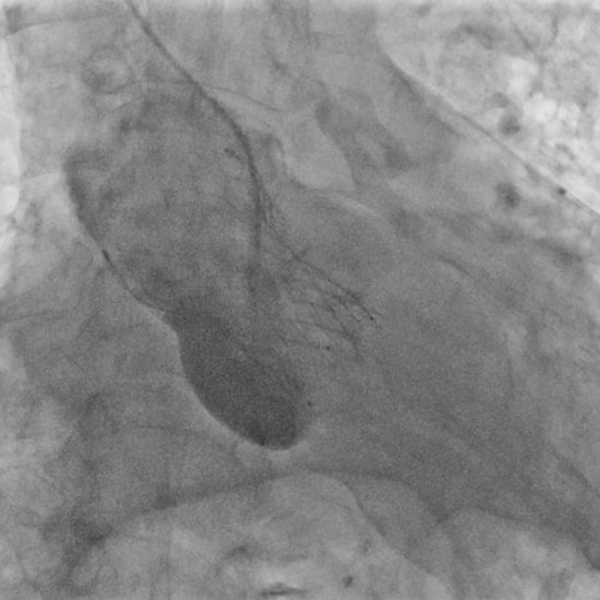 A 34-mm Evolut transcatheter aortic valve (TAV) (Medtronic) was deployed with a good result (Figure 1G)