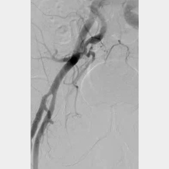 Figure 1H: Femoral angiogram demonstrated successful percutaneous closure.