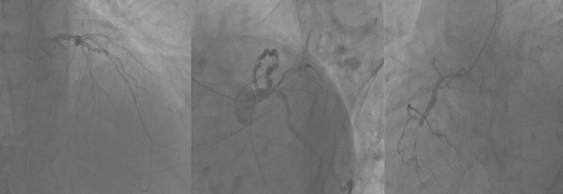 Supplementary Figure 1: Pre-procedural coronary angiography showing severe distal left main disease with critical involvement of the left anterior descending artery (LAD) and chronic total occlusion (CTO) of the dominant right coronary artery (RCA).