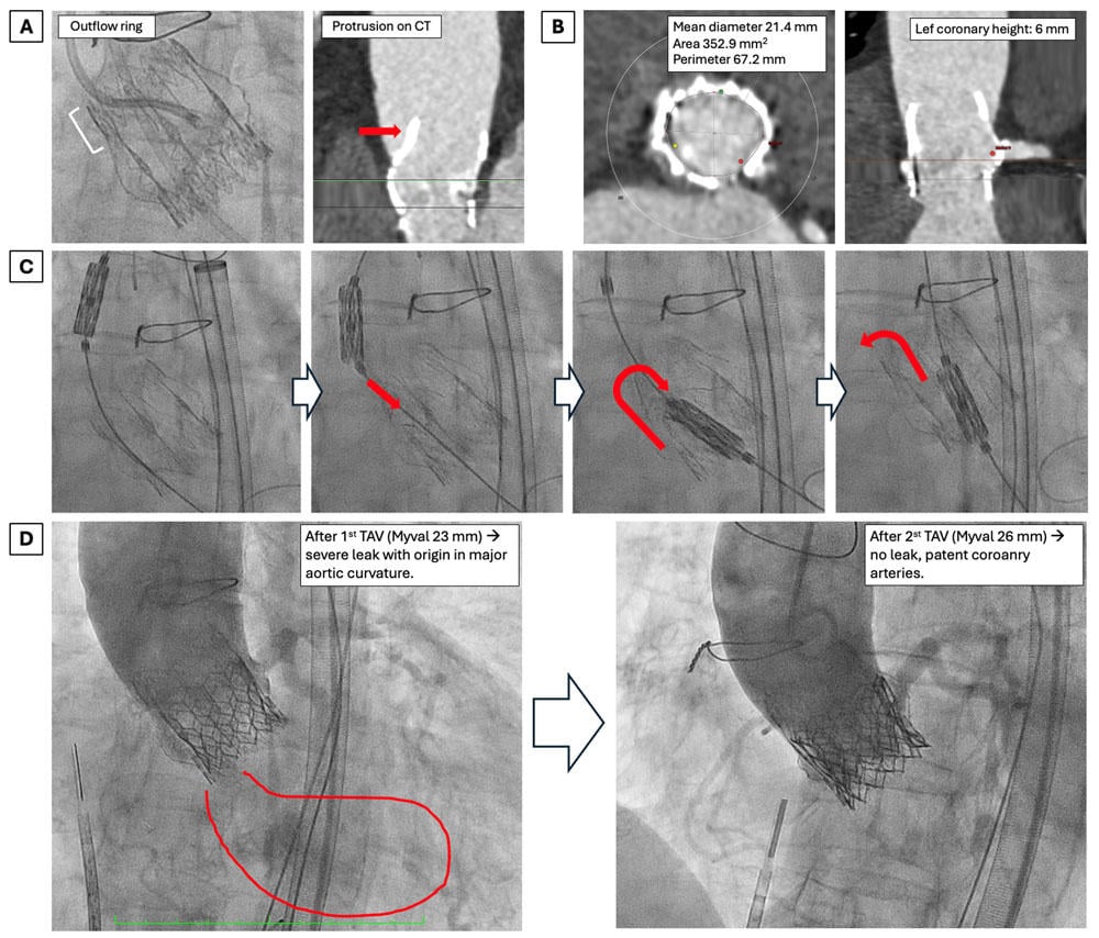 Figure. (A) Perceval S bioprosthesis and outflow ring protrusion. (B) Cardiac computerized tomography showing annulus dimensions and left coronary height. (C) Sequence showing crushing and inward folding of the Perceval during valve crossing with the Myval TAV. (D) Angiographic result after 1st and 2nd transcatheter aortic valve (TAV) implantation.