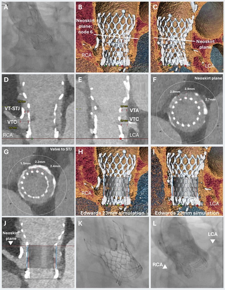 TAVI-in-TAVI-in-valve for cardiogenic shock with high coronary obstruction risk.