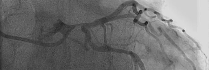 Isolated left main stenosis in a young patient with low syntax score