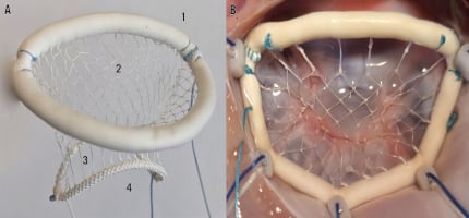Chordal replacement and annuloplasty in one transfemoral device for degenerative mitral regurgitation