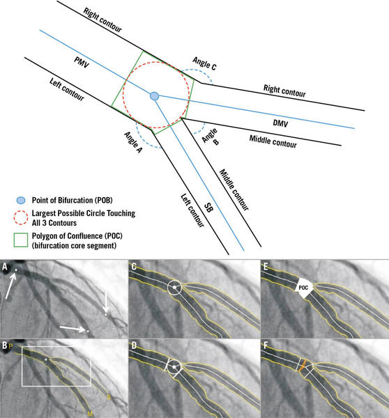 Figure 2. Coronary bifurcation composition