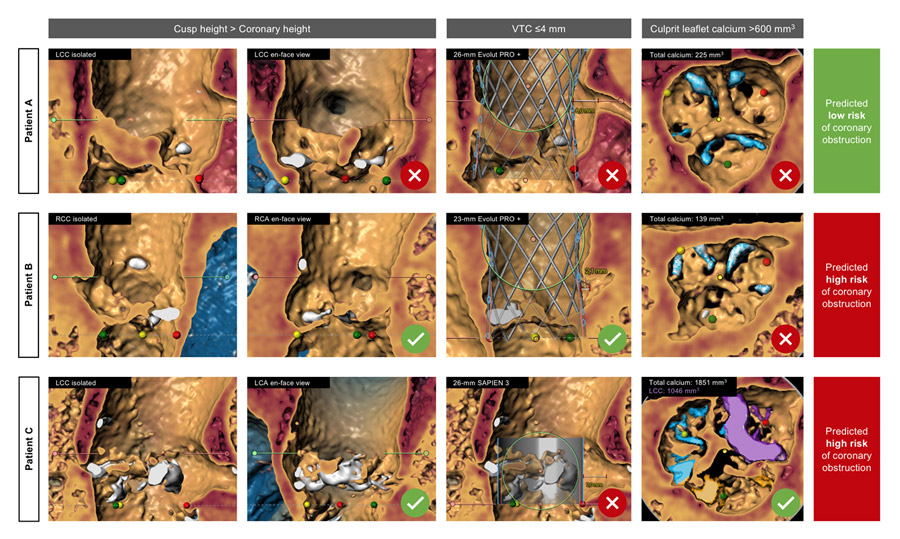 Figure 1: Practical application of the proposed algorithm for CO risk assessment after TAVI in native AS. Different clinical scenarios highlight the importance of multiparametric assessment.