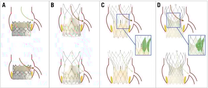 Figure 4. Coronary access according to valve design and implantation depth. Coronary engagement after previous SAPIEN 3 (A) implantation is commonly feasible with standard catheters, and the access route may be least impaired (green arrow); engagement across the stent frame (red arrow) may become necessary only in the case of high THV positioning or low coronary take-off. Potential access routes for the ACURATE neo valve (B) may be via the stabilisation arches (red arrow) or from outside the valve frame (dotted green arrow). The common access route in tall-frame valves ([C] Portico/Navitor; [D] Evolut) is across the uncovered stent struts above the leaflet plane (red arrows), whereas, especially in patients with a wide sinotubular junction or sinus of Valsalva, an access route from outside the valve frame (dotted green arrows) may be an alternative. The lower leaflet position and the larger cells of the Portico/Navitor THV stent frame may facilitate coronary catheterisation in comparison with the Evolut platform. Regardless of the THV type, correct commissural alignment of the prosthesis will usually facilitate coronary access. THV: transcatheter heart valve