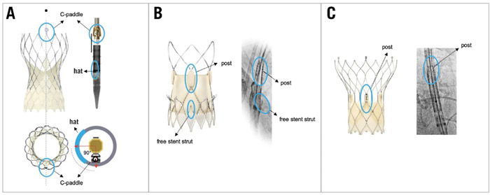 Figure 6. THV-specific fluoroscopic markers of the THV commissural posts. THV-specific fluoroscopic markers identifying prosthetic neocommissures in different types of expanded and crimped THVs. A) CoreValve Evolut platform; B) ACURATE neo2 platform; C) Portico/Navitor platform. THV: transcatheter heart valve. Source: EuroIntervention Journal