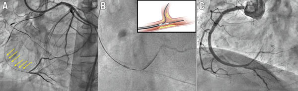Figure 1. Dual lumen microcatheter in bifurcation lesions associated with CTO. Example of a right coronary artery CTO with a bifurcation at the distal cap and a long proximal dissected segment (arrows).