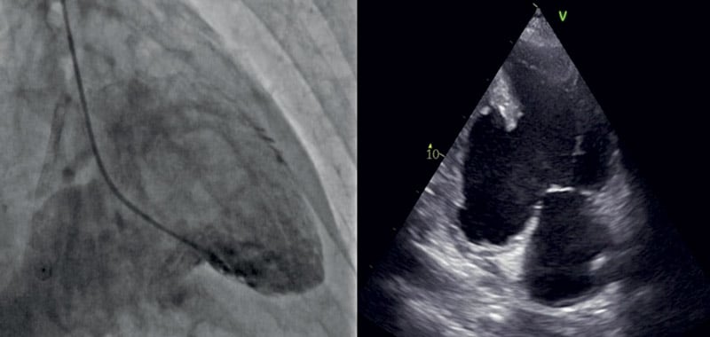 A giant pseudoaneurysm of the inferior LV wall revealed at LV gram was confirmed by an echocardiogram. 