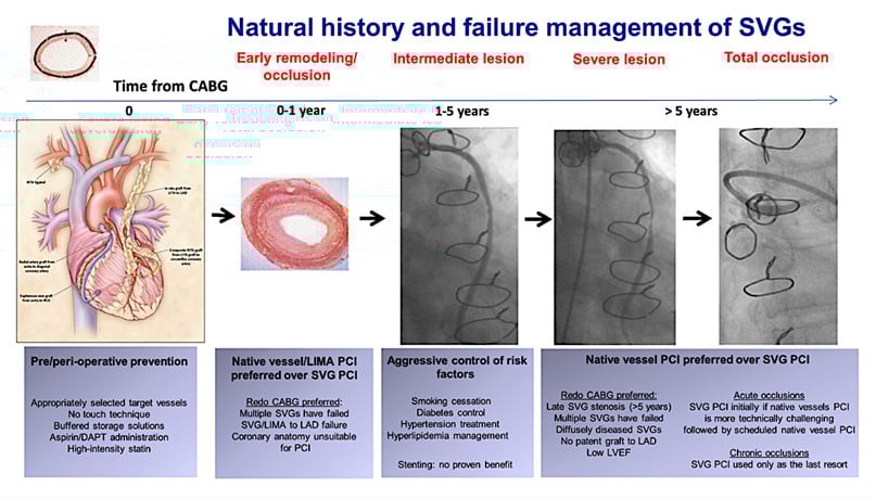 PROCTOR: Figure 1: Natural history and failure management of saphenous vein grafts