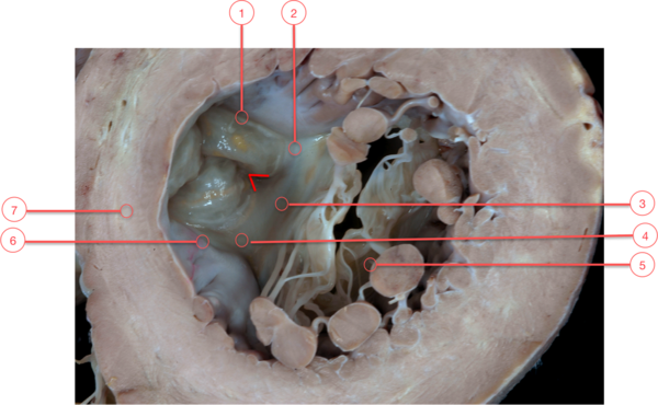 Figure 10. Ventricular aspect of aortic and mitral valves