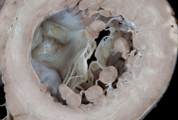 Figure 10. Ventricular aspect of aortic and mitral valves