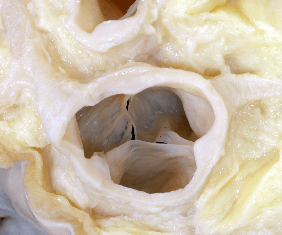 Figure 5. Normal trileaflet aortic valvar leaflets
