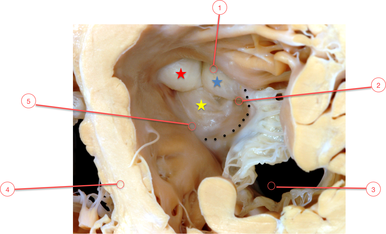 Figure 6. Normal trileaflet aortic valve leaflets
