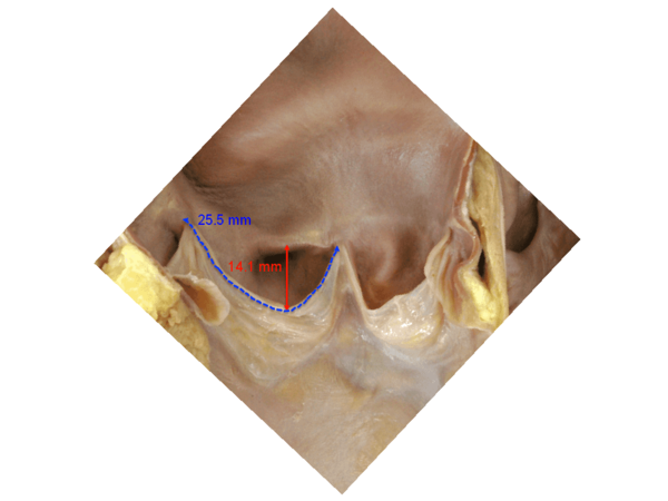 Figure 7. Dimensions of aortic leaflets