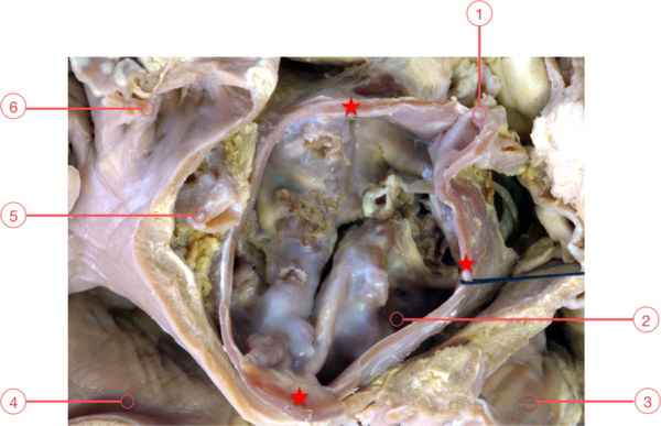 Figure 8. Calcific aortic stenosis