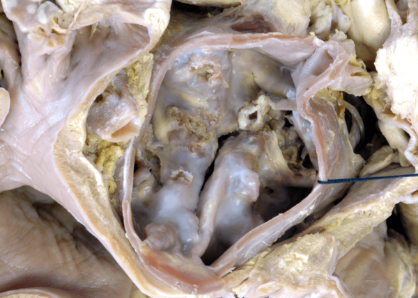 Figure 8. Calcific aortic stenosis