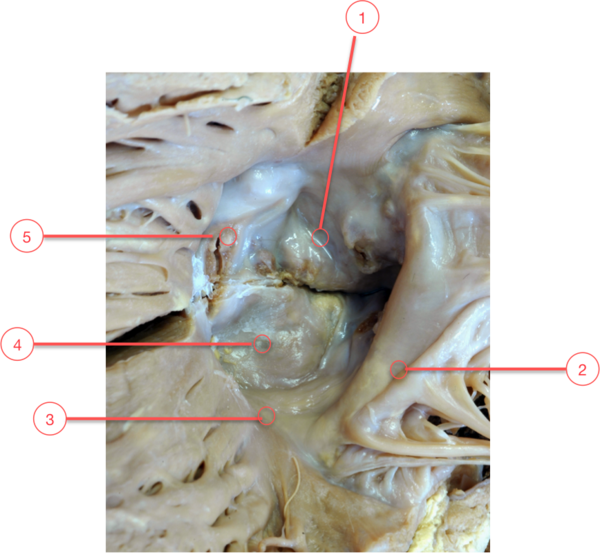 Figure 9. Calcific aortic stenosis