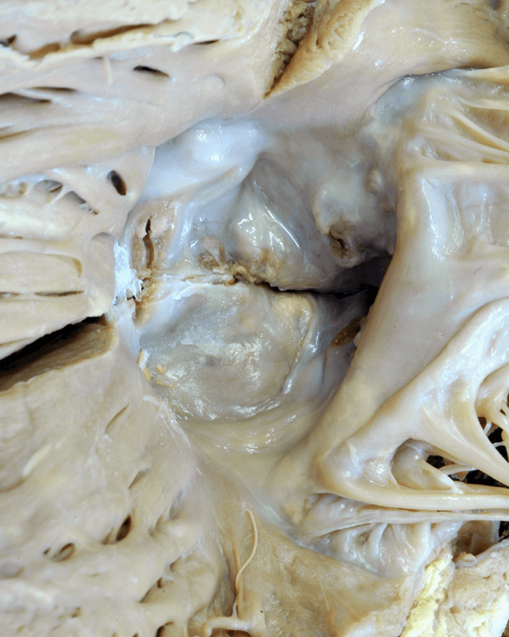 Figure 9. Calcific aortic stenosis