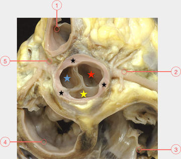Figure 3. Aortic sinuses